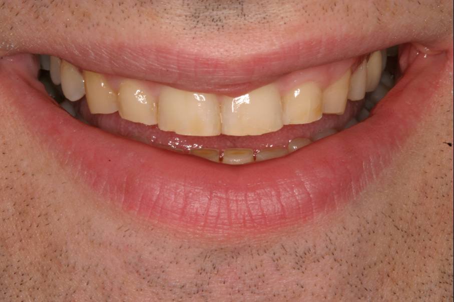 Before dental treatment - Case 1